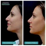 Nehirurška korekcija nosa 1