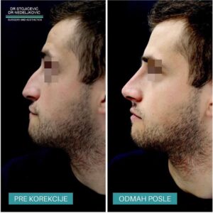 Nehirurška korekcija nosa 3
