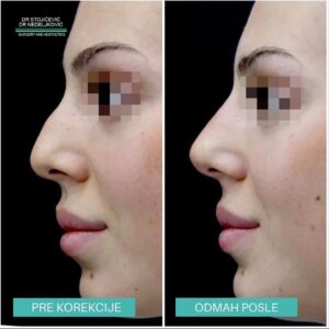 Nehirurška korekcija nosa 4