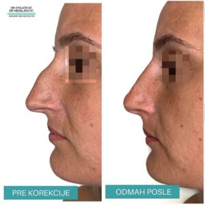 Nehirurška korekcija nosa 6