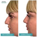 Nehirurška korekcija nosa 7