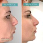 Nehirurška korekcija nosa 8