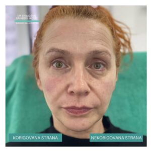 Korekcija podočnjaka hijaluronskim filerima 3