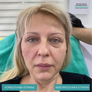 Korekcija podočnjaka hijaluronskim filerima 5
