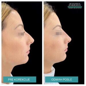Nehirurška korekcija nosa 11