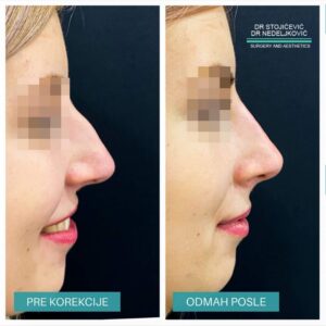 Nehirurška korekcija nosa 13