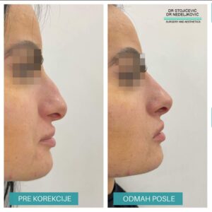 Nehirurška korekcija nosa 14