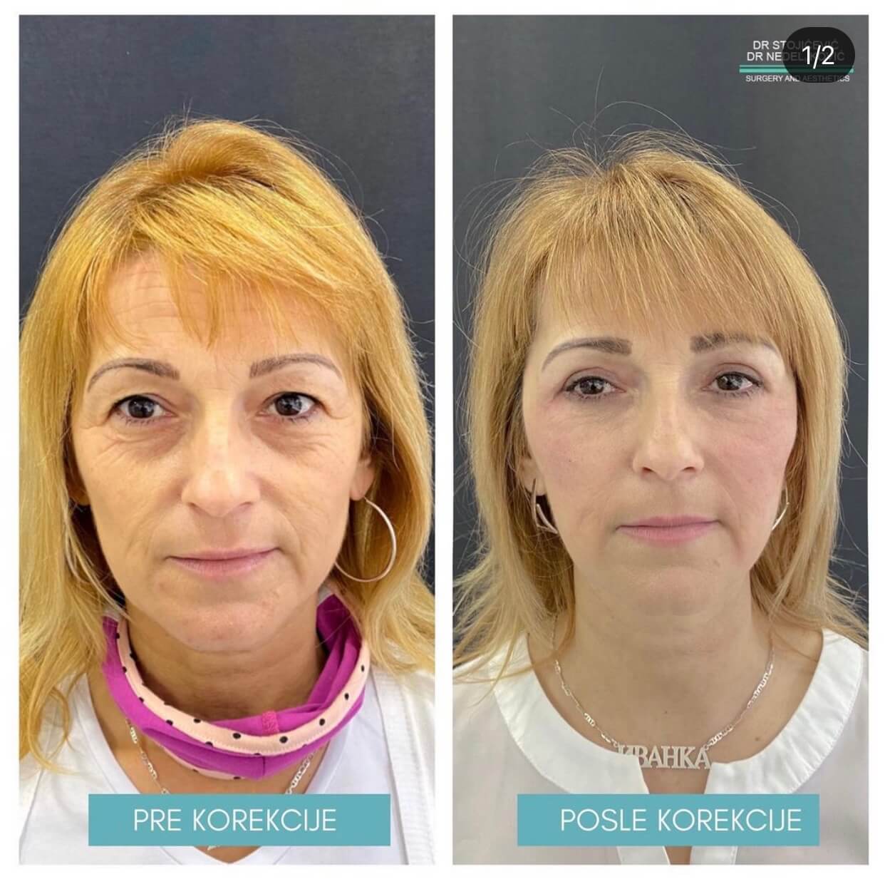 blefaroplastika