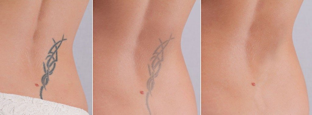 lasersko uklanjanje tetovaza
